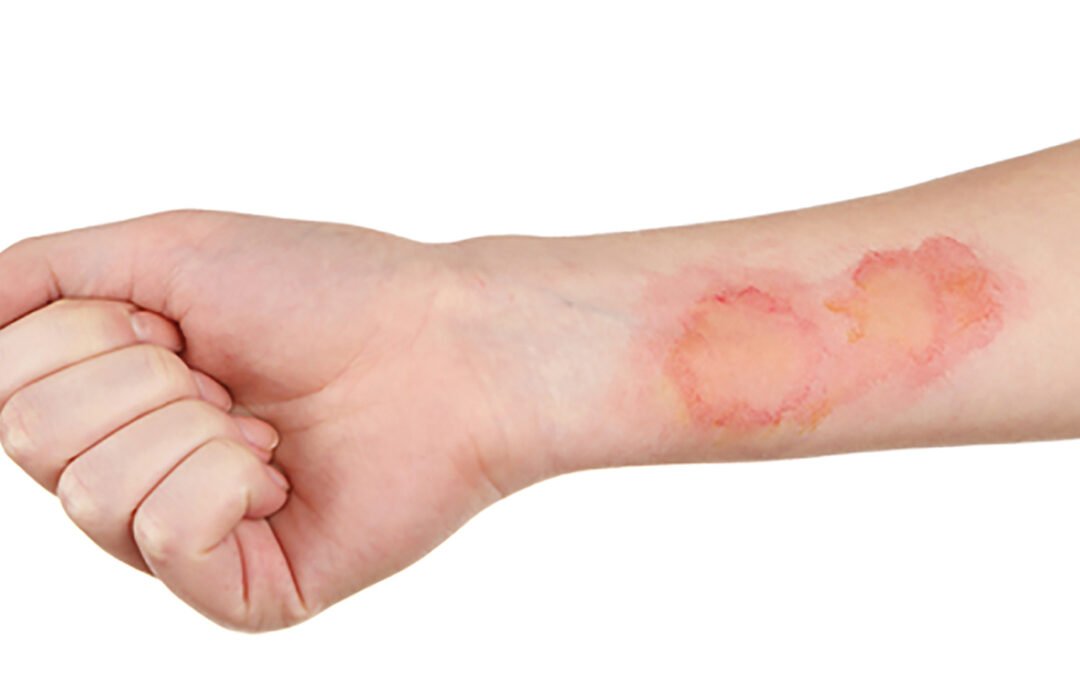 انسَ كل ما تعرفه عن علاجات الحروق