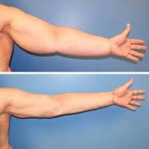 الوذمة اللمفية بعد عملية استئصال الثدي