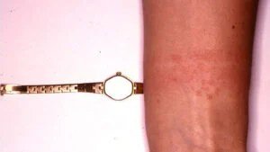 التهاب الجلد التماسي