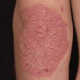 الصدفية المحمرة للجلد